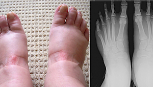 Máte oteklé nohy? Může to být příznakem 7 závažných onemocnění. 